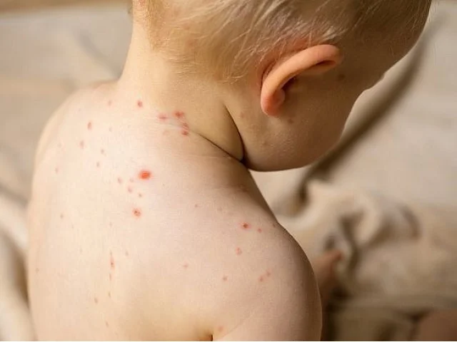 Kanada ztratila status země bez spalniček. Důvodem je nízká proočkovanost