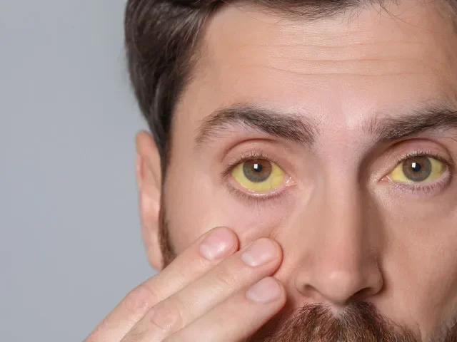 Žloutence typu A v Praze podlehlo od začátku roku 13 lidí. Za týden se nakazilo víc lidí než za celý loňský rok