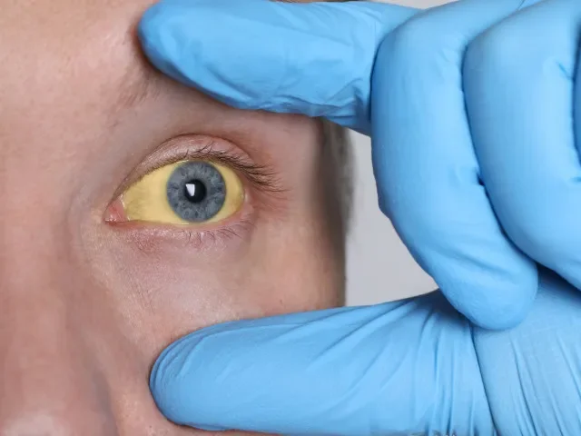 Polsko se omluvilo za chybné informace o žloutence. Občany před cestami do Česka nevarovalo