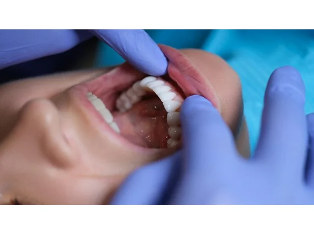 Místo amalgámu budou hrazené bílé výplně. Někteří zubaři poukazují na problémy