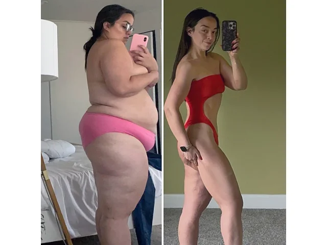 Žena zhubla čtyřiašedesát kilo, bez plastiky se poté neobešla