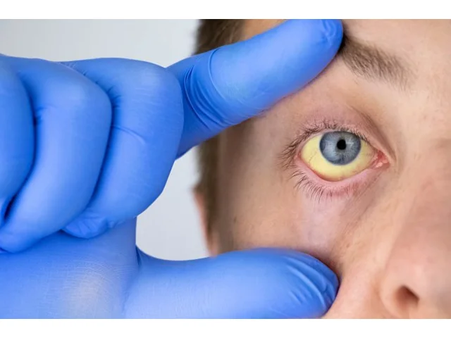 Deset mrtvých, stovky nemocných. Prahu sužuje nezvykle silná epidemie žloutenky