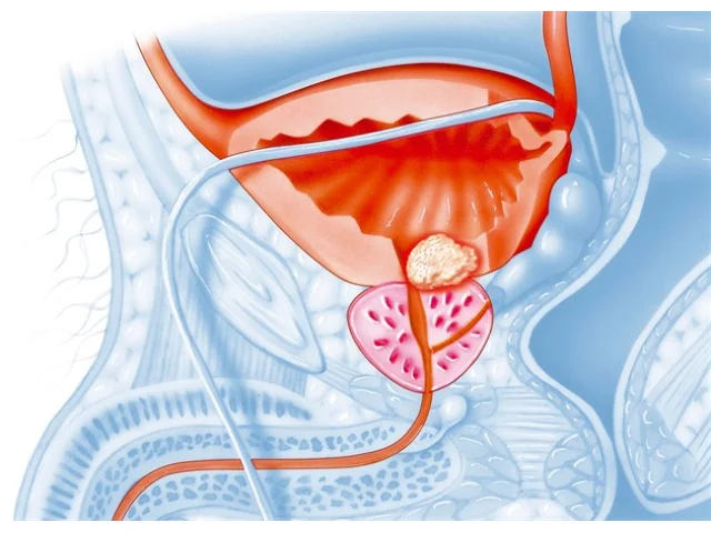 Rakovina prostaty nebolí. Jak poznat varovné příznaky?
