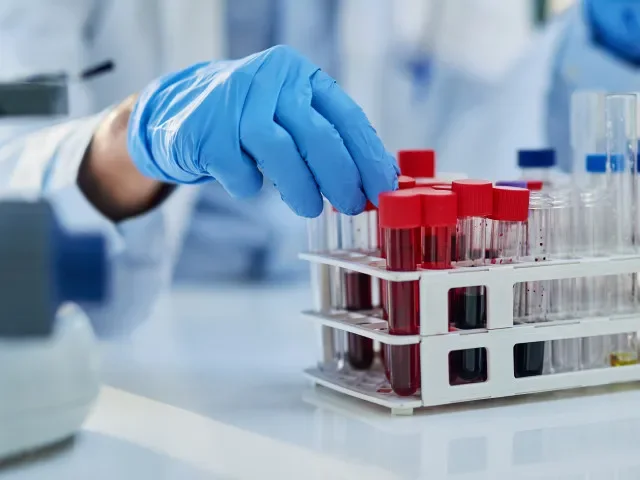 Případů žloutenky typu A je nejvíc od roku 1996, Praha čelí lokální epidemii