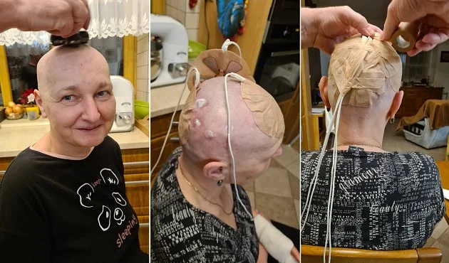 S elektrodami na hlavě proti rakovině? Jaroslava z Teplicka líčí drsnou realitu