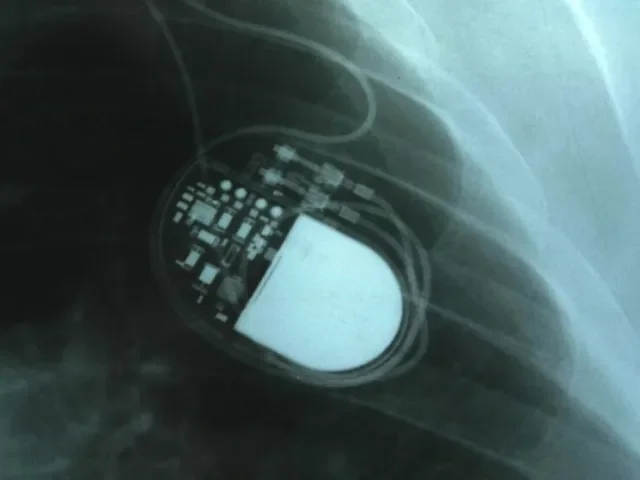 Policie vyšetřuje podezření z těžkého ublížení na zdraví u stovek pacientů s implantovanými defibrilátory