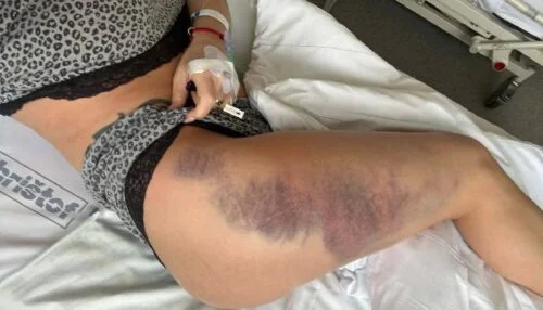 Modřina způsobená pádem po mrtvici má dohru. Andrea Kašpárková přiznala, že musí na operaci