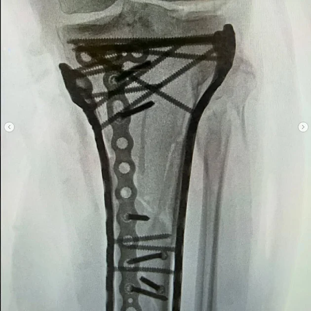 Už pátá operace, šest hodin dlouhá. Bolest zvládám těžko, přiznává Vonnová