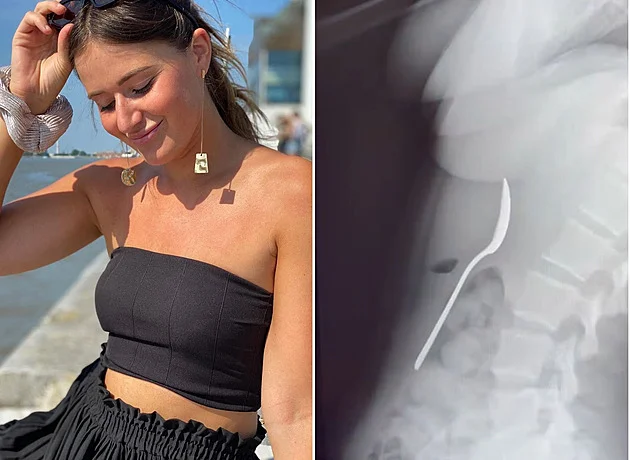 Žena spolkla celou lžičku, mohla za to bizarní nehoda - Krimi iDnes.cz článek na Media24.cz